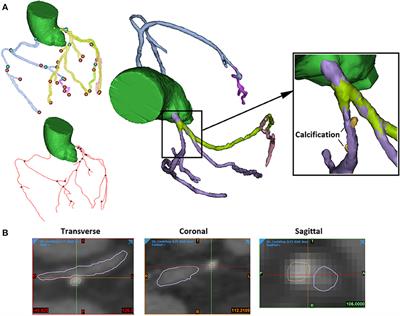 Consistency in Geometry Among Coronary Atherosclerotic Plaques Extracted From Computed Tomography Angiography